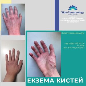Екзема кистей