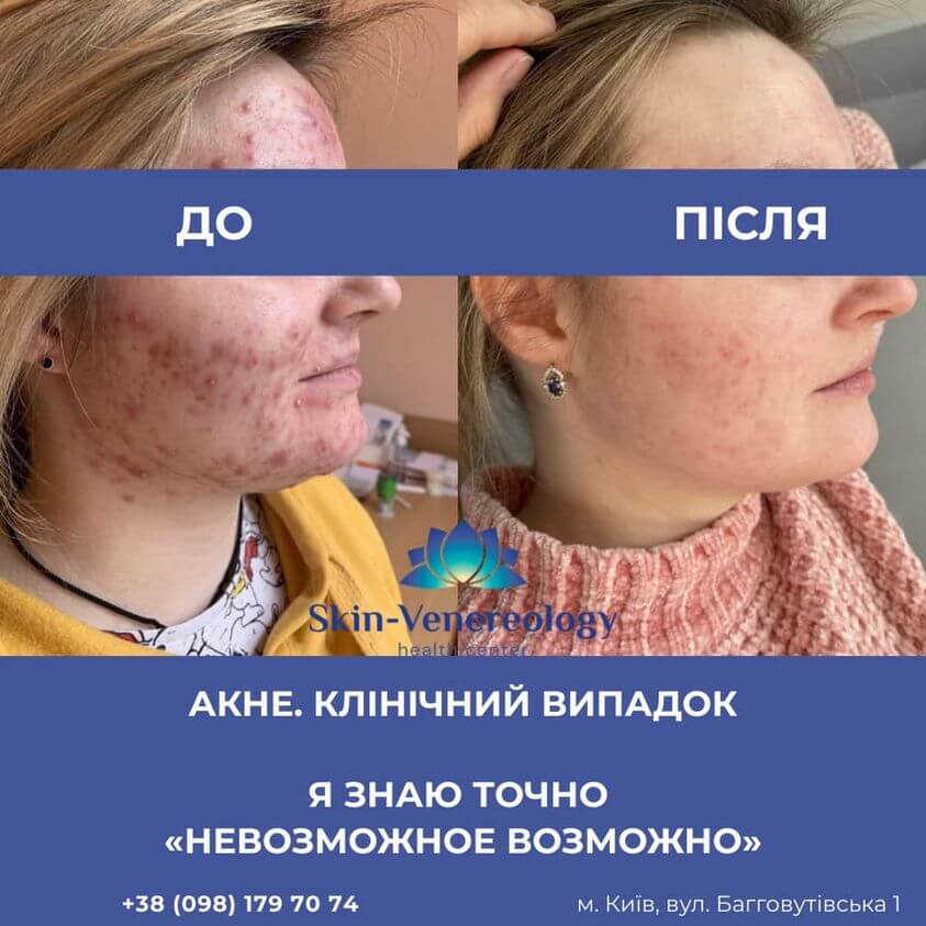 лікування акне