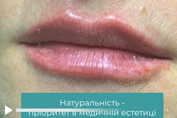 Натуральні губи у Скін Венеролоджі